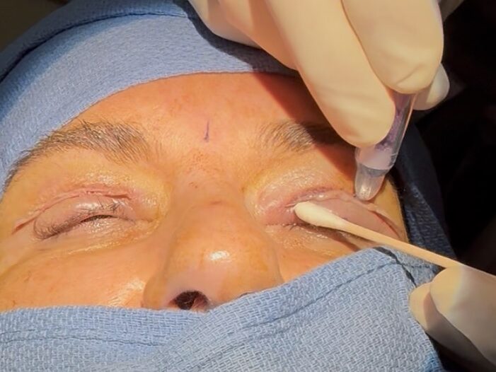 Skin adhesive applied along the upper-eyelid incision with a cotton-tipped applicator