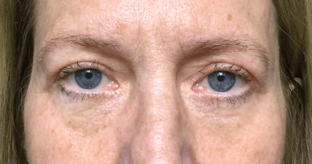 Case 01 after Ziplyft: upper eyelids after treatment