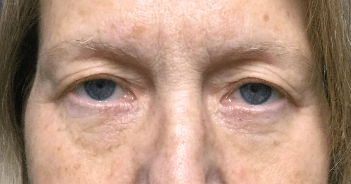 Case 01 before Ziplyft: upper eyelids with excess skin